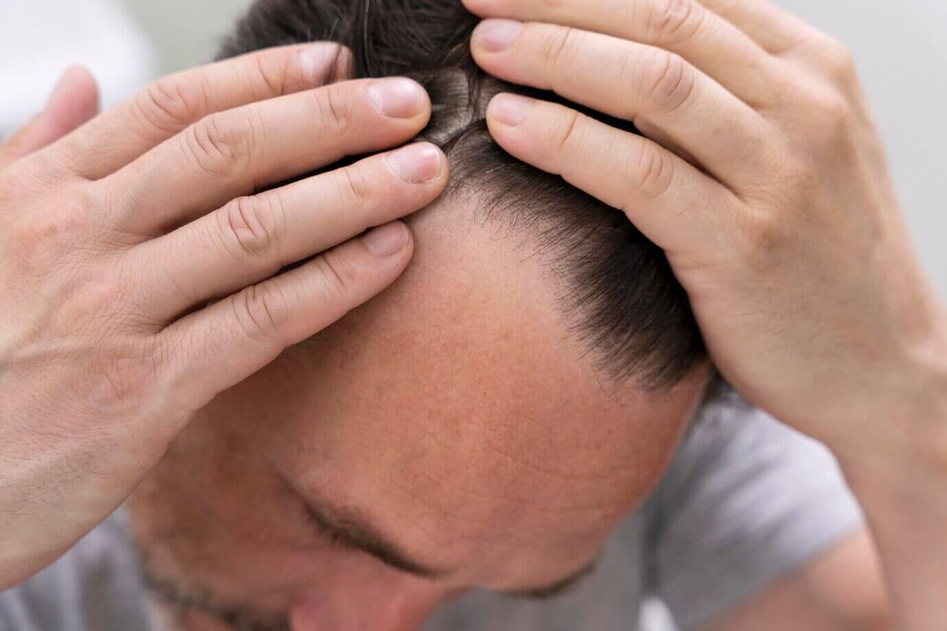 MALE PATTERN BALDNESS